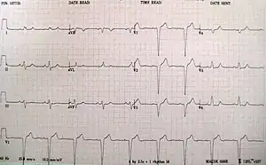 A left bundle branch block