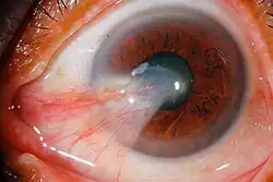 Large primary pterygium invading the pupil (visual axis)