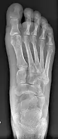 Left big toe joint shifted in sideway due to overcorrection