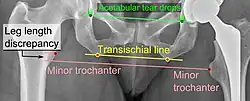 Leg length discrepancy after hip replacement is calculated as the vertical distance between the middle of the minor trochanters, using the acetabular tear drops or the transischial line as references for the horizontal plane. A discrepancy of up to 1 cm is generally tolerated.