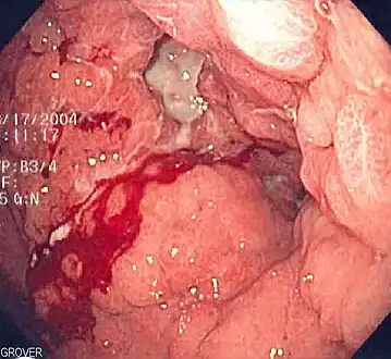 Endoscopic image of linitis plastica, a diffuse type of stomach cancer characterized by a thickening and rigidity of the lining of the stomach, leading to a leather bottle-like appearance with blood coming out of it