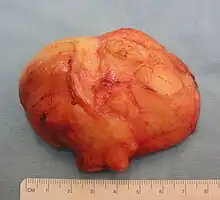 The resected lipoma (8&nbsp;cm × 6&nbsp;cm × 3&nbsp;cm)