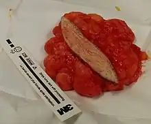 This lipoma was removed from the thigh of a 39-year-old male patient. It measured about 10&nbsp;cm in diameter at the time of removal. In the center is a section of skin which was removed with the lipoma.