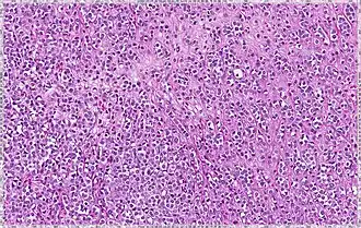 Lobular breast cancer. Single file cells and cell nests.