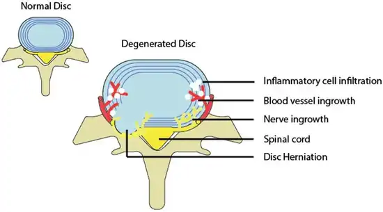 Image depicting a normal and degenerated disc accompanied by inflammation.[32]