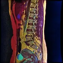 Color MRI showing nabothian cyst as small blue circle in cervical region.