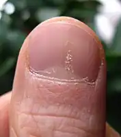 Psoriasis of a fingernail, with visible pitting