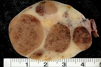 Luteoma-of-pregnancy