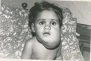 Same patient after first surgery