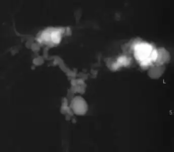 Magnetic resonance cholangiopancreatography (MRCP) of Caroli disease, showing cystic dilatations of bile ducts.[1]