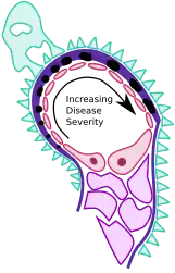 Immune complexes (black) are deposited in a thickened basement membrane creating a "spike and dome" appearance on electron microscopy.