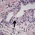 Adenocarcinoma with two mitoses in reactive epithelium.