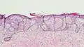 Fibroepitheliomatous pattern (anastomosing basaloid epithelial strands enclosing round islands of fibrous stroma)[23]