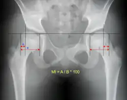 Reimer's migration index can be used to indicate hip dislocation. The migration index (MI) is normally less than 33%.[18]