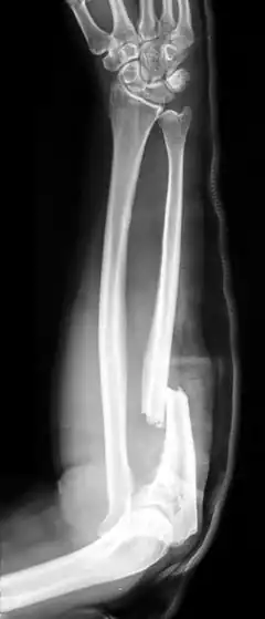 Monteggia fracture