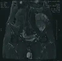MRI of a left-pelvis chondrosarcoma in a 26-year-old male
