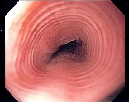 Endoscopic image of esophagus in a case of eosinophilic esophagitis. Concentric rings are termed trachealization of the esophagus.