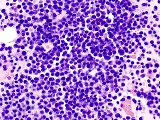 Bone marrow aspirate showing the histologic correlate of multiple myeloma under the microscope, H&E stain