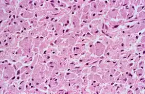 Mycobacterium avium-intracellulare infection, thin section from a lymph node [15]