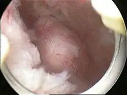 Submucosal fibroid in hysteroscopy