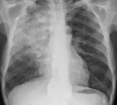 Obstructive pneumonia in the right lung (left side of the image) from a blockage in the respiratory tract.
