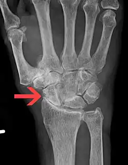 Severe osteoarthritis and osteopenia of the carpal joint and 1st carpometacarpal joint.