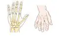 Bone (left) and clinical (right) changes of the hand in osteoarthritis