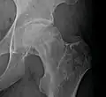 Radiography of avascular necrosis of left femoral head. Man of 45 years with AIDS.