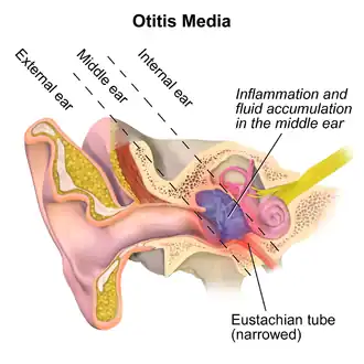 Otitis media.