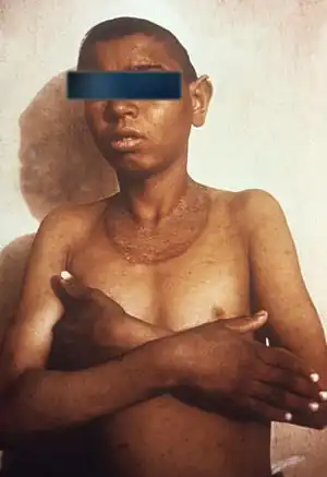 This child has the skin rash associated with pellagra