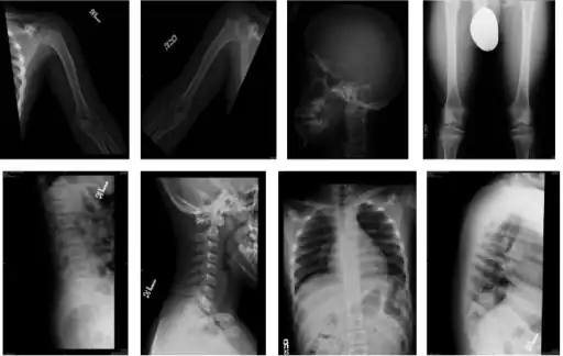 Skeletal survey in favor of hypochondroplasia