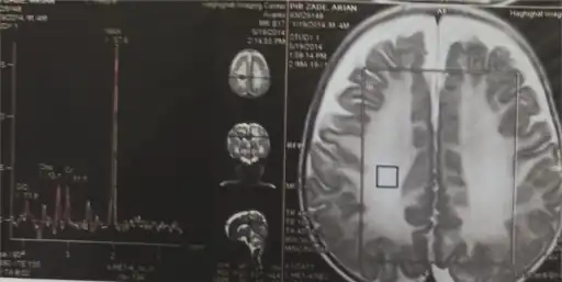MRS in individual with Canavan disease shows a markedly increased level of N-acetylaspartic acid