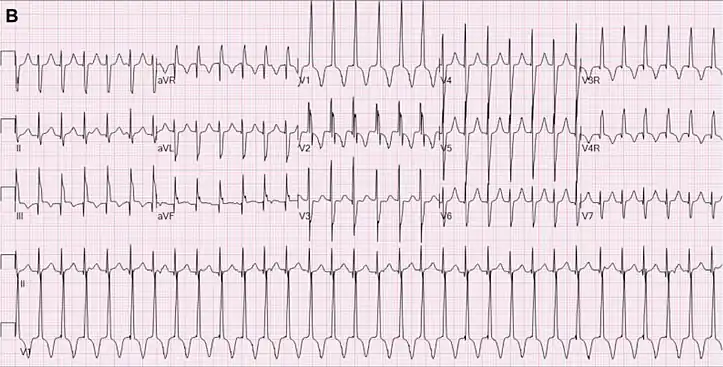 JET in a 2-month-old girl following cardiac surgery. In this case the right bundle branch block was present during tachycardia and during normal sinus rhythm.