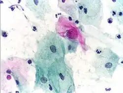 An obviously atypical cell can be seen