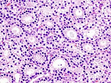 Histopatholgical image of parathyroid adenoma in a patient with primary hyperparathyroidism. Hematoxylin and eosin stain. Another view of the same lesion