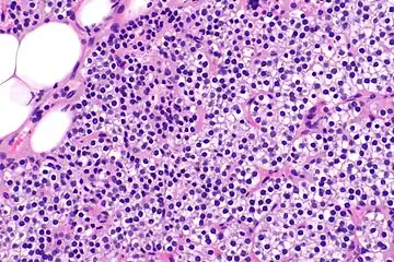 Parathyroid hyperplasia high mag.