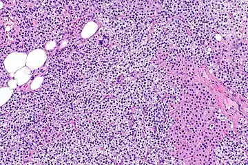 Parathyroid hyperplasia medium mag.