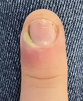Acute paronychia in a women who chews her nails