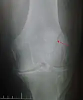 Vertical patella fracture