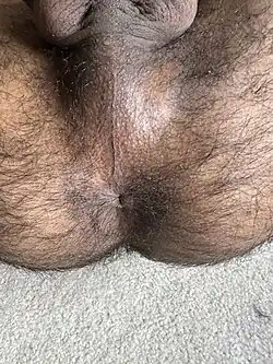 Another example of the perineal raphe in an adult human male.