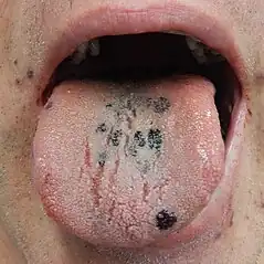 Petechia on the tongue in a person with platelets of 3 due to ITP