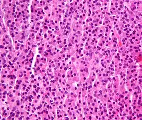 Plasmacytoma, H&E stain