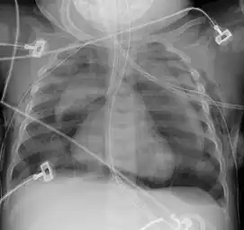 Pneumomediastinum with angel wing sign[14]