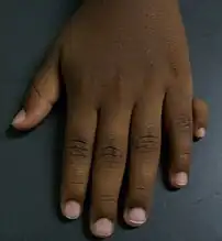 Type 1 ulnar polydactyly. An extra digit is attached by skin and nerves.