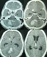 Axial CT scan showing hemorrhage in the posterior fossa[10]