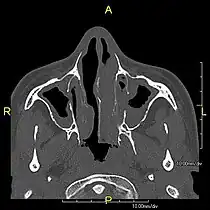 Axial CT image showing chronic sinusitis in an individual with Kartagener syndrome