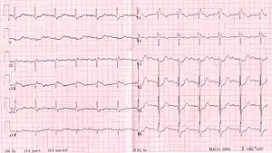 RBBB with associated first degree AV block
