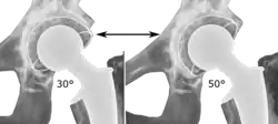 Acetabular inclination is normally between 30 and 50°. A larger angle increases the risk of dislocation.