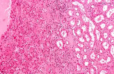Micrograph of a renal oncocytoma. H&E stain.