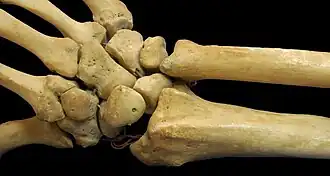 Distal ends of radius and ulna along with the bones of the wrist and hand